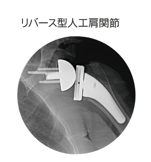肩腱板断裂性関節症の手術写真